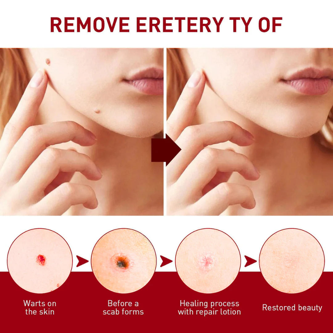 Tags & Moles Remover (Buy 1 Get 1 Free - Pack of 2)